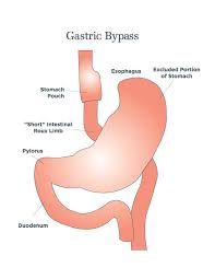 Gastric Bypass Abu Dhabi